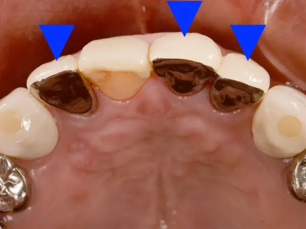 上大岡駅の歯医者「アーバン歯科・上大岡駅前院」は硬質レジン前装冠を用いた治療を行っています