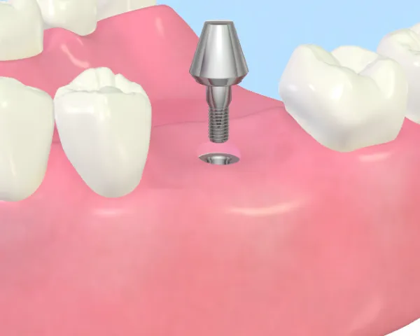 上大岡駅の歯医者「アーバン歯科・上大岡駅前院」のインプラント治療はアバットメントを取り付けます