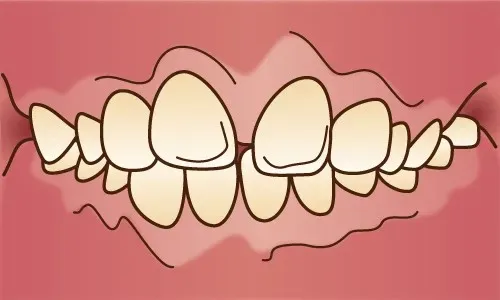 上大岡駅の歯医者「アーバン歯科・上大岡駅前院」の矯正歯科は出っ歯（上顎前突）の症例に対応しています