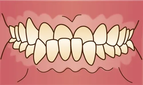 上大岡駅の歯医者「アーバン歯科・上大岡駅前院」の矯正歯科は受け口（反対咬合）の症例に対応しています