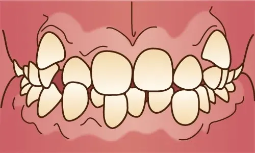 上大岡駅の歯医者「アーバン歯科・上大岡駅前院」の矯正歯科は乱ぐい歯・八重歯（叢生）の症例に対応しています