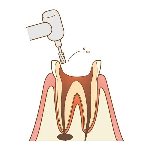 上大岡駅の歯医者「アーバン歯科・上大岡駅前院」の根管治療は虫歯に冒された歯質を削り取ります