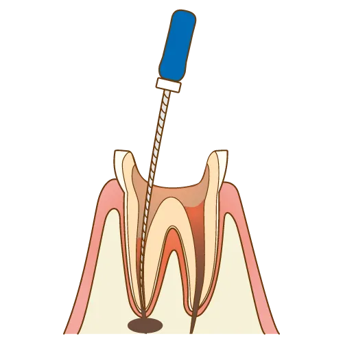 上大岡駅の歯医者「アーバン歯科・上大岡駅前院」の根管治療は神経が通っているスペースに穴を開けます