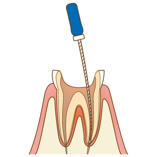 上大岡駅の歯医者「アーバン歯科・上大岡駅前院」の根管治療は歯根の感染部分を除去します