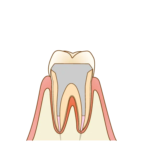 上大岡駅の歯医者「アーバン歯科・上大岡駅前院」の根管治療は最後に詰め物もしくは被せ物で補います