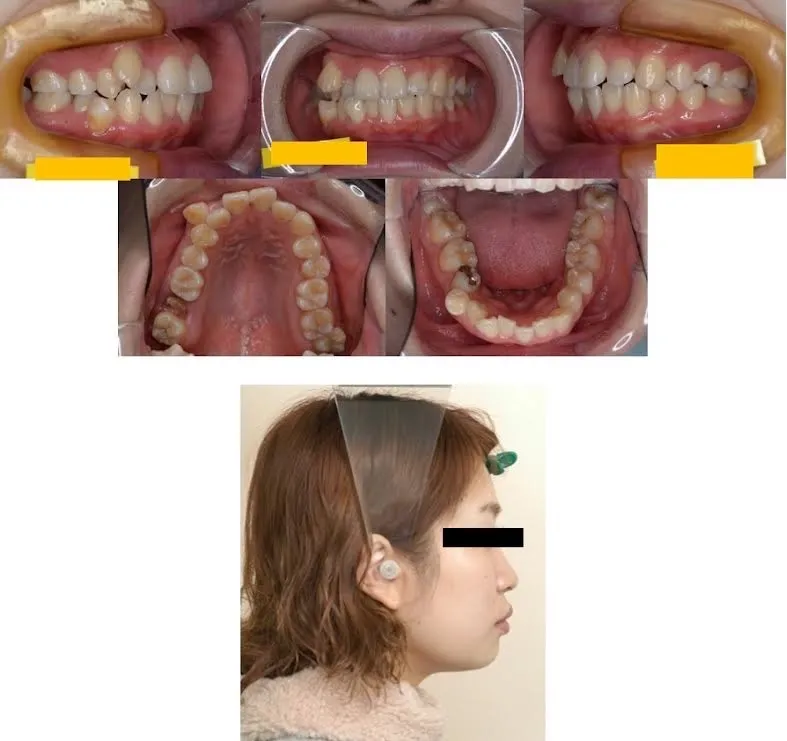 上大岡駅の歯医者「アーバン歯科・上大岡駅前院」のワイヤー矯正施術前の状態です