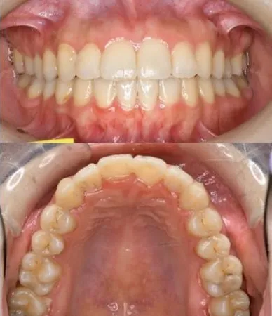 上大岡駅の歯医者「アーバン歯科・上大岡駅前院」の裏側矯正治療後の状態です