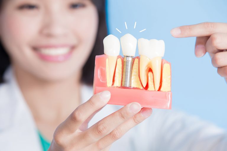 インプラント治療を徹底解説！費用・メリット・リスクも紹介